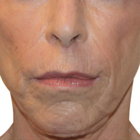 RF Skin Tightening Diamond Polar RF Skinlux Face and Body