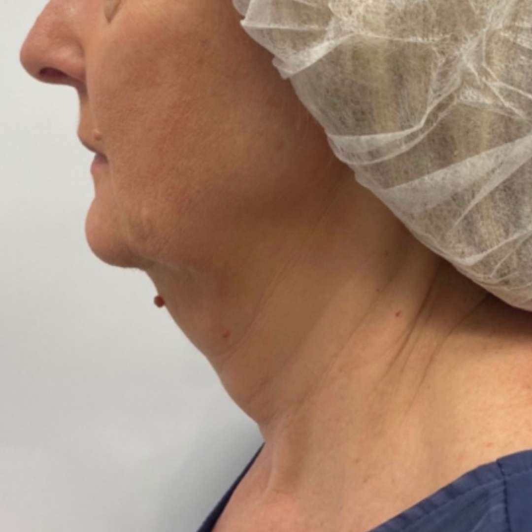 HIFU High Intensity Focused Ultrasound (HIFU) Skinlux Face and Body